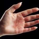 Коварный дерматит на руках: лечение