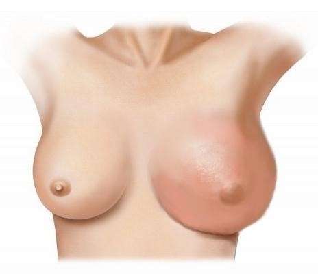 Рак груди у женщин симптомы