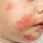 Атопический дерматит у ребенка: причины, симптомы, лечение