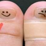 Злосчастный грибок на ногтях ног: лечение народными средствами