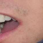 Как лечить заеды в уголках губ народными способами и с помощью лекарственных препаратов