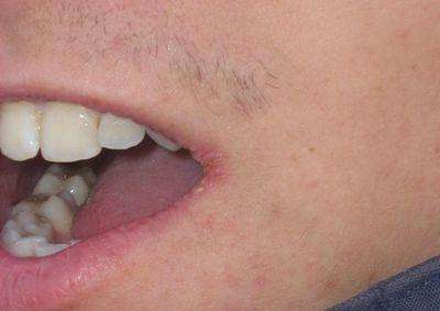 как лечить заеды в уголках губ