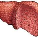 Жировой гепатоз - что это такое, и как его лечить?