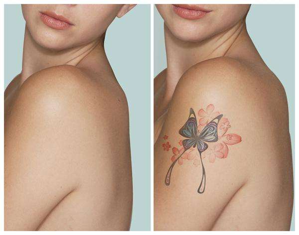 удаление татуировок лазером в москве