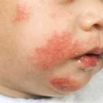 Атопический дерматит у ребенка: лечение и симптомы