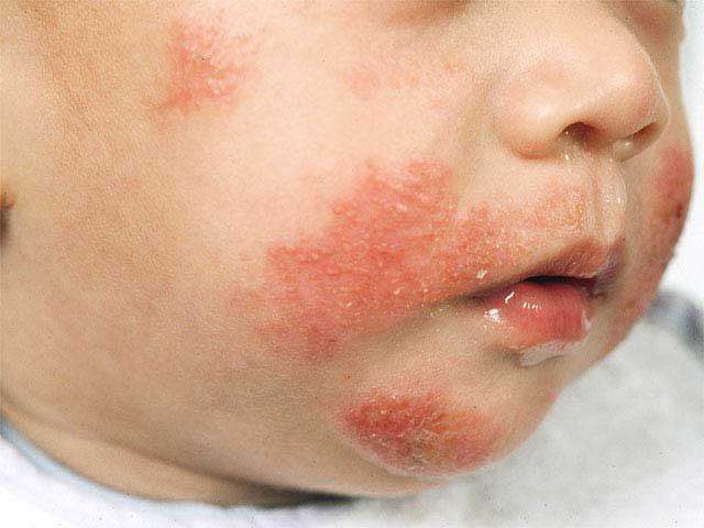 атопический дерматит у ребенка лечение