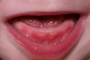 Может ли быть кашель при прорезывании зубов: причины, методы лечения и рекомендации врачей