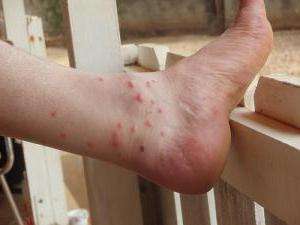 аллергическая реакция на укус комара