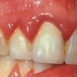 Гингивит: чем полоскать рот при воспалении десен?
