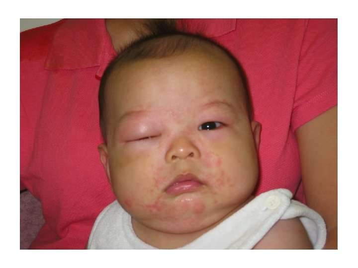 Аллергия у малышей