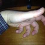 Свело палец на руке: причины, лечение и профилактика