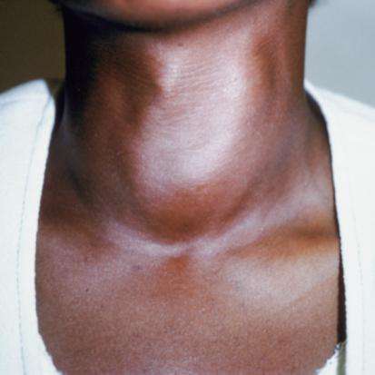 признаки щитовидки