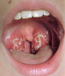 стафилококк в горле симптомы 