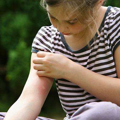Лечение укусов комаров у детей