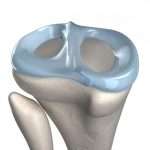 Миниск коленной чашечки: виды травм, лечение
