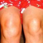 Что такое киста Беккера коленного сустава?
