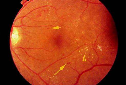 ангиопатия сосудов сетчатки глаза 