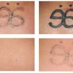 Избавляемся от ошибок прошлого: удаление татуировки лазером