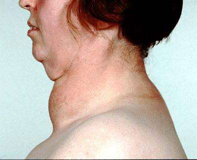первые признаки щитовидки